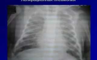 Аспирация легких у новорожденных